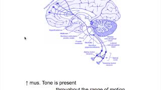 Extrapyramidal neuron lesionRigiditySpasticity VS Rigidity [upl. by Tempa]