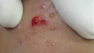 Treatment of Molluscum Contagiosumwmv [upl. by Niamrahc]