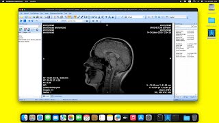 MicroDicom DICOM Viewer on macOS Sequoia using Wine [upl. by Alaet72]