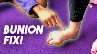 HOW TO FIX A BUNION  Episode 1 [upl. by Ethelin]