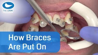 How braces are put on  AMAZING   Now with 12 month  Progress  httpsgoogljXaY15 [upl. by Evita]