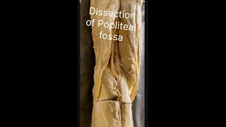 Popliteal fossa Dissection of popliteal fossa Anatomy of popliteal fossa Contents popliteal fossa [upl. by Setarcos]