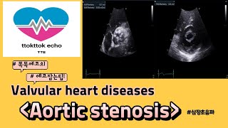 Aortic stenosis AS aortic valve 대동맥판막 협착증 echocardiography 심장초음파 heart echo view [upl. by Nohsar286]