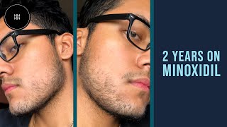 Minoxidil Beard Journey 2 Years [upl. by Annekim]