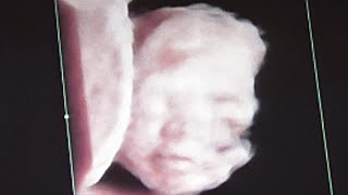 23 Weeks Old Fetus Smiling in mothers Womb  Ultrasound [upl. by Andonis]