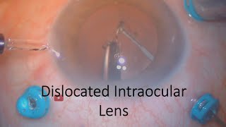 Dislocated Intraocular Lens  Cataract Complications [upl. by Ahcropal]