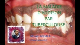 LA MALADIE DADDISON PAR TUBERCULOSE [upl. by Ylrebme]