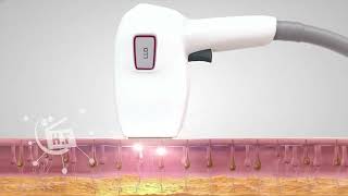 laser hair removal process by milesman laser [upl. by Donelle]