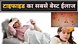 टाइफाइड बुखार का बेस्ट ईलाज  Typhoid fever treatment  S Typhi  best medicine [upl. by Auqenwahs]