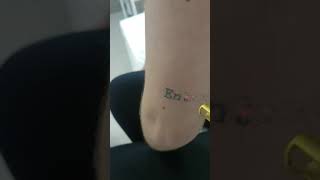 REMOÇÃO DE TATUAGEM A LASER [upl. by Thorstein973]