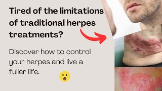 Natural supplements Herpes Relief Solution [upl. by Duile260]