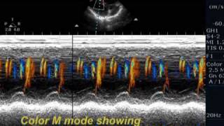 Unusual ventricular septal defect [upl. by Gracia321]