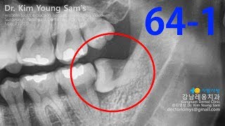 horizontal impacted wisdom tooth extraction [upl. by Goren]