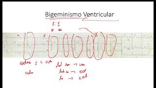 Bigeminismo y Trigeminismo  Extrasistole Auricular y Ventricular EKG [upl. by Sualkcin]