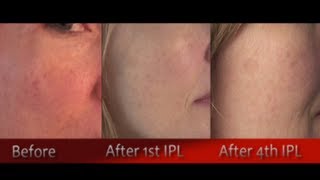 IPL Photofacial Review After 4 Treatments  Before amp After [upl. by Atinej]