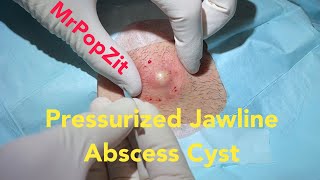 Pressurized Jawline Abscess Cyst Squirting cyst pop with surprising large sac dissection on neck [upl. by Sedgewake]