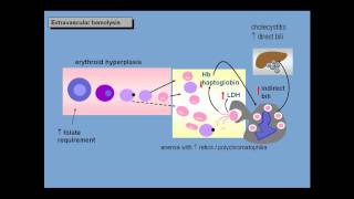 Anemia of increased red cell destruction loss [upl. by Glynias215]