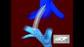 Endoprosthesis  Transjugular Intrahepatic Portosystemic Shunt TIPS [upl. by Love]