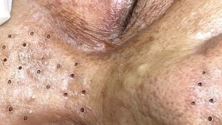 Relax everyday with Blackheads 0475 [upl. by Yluj223]