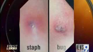 Bug Bites vs Staph Infections [upl. by Suu925]