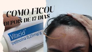 VITACID  Como ficou minha acne depois de 17 dias usando Vitacid [upl. by Calandra]