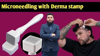 microneedling derma stamp derma roller hair regrowth  hair loss treatment  how to use derma Roler [upl. by Dor946]