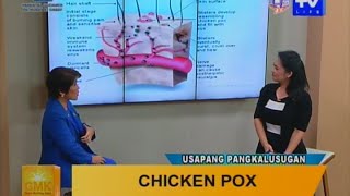 Good Morning Kuya Chicken Pox  Symptoms and Treatment [upl. by Naval]