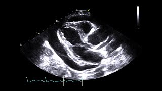 Pericardial Tamponade From a Fractured Inferior Vena Cava IVC Stent [upl. by Mast]