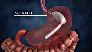 The Possible Dangers of Gastric Balloons for Weight Loss [upl. by Hguh]