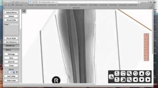 Bonesetter App templating a distal tibia fracture [upl. by Lipinski]