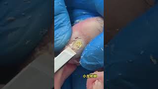 Ingrown Toenail Removal Procedure [upl. by Drhacir]