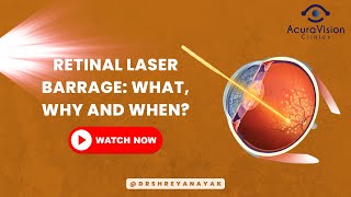 Retinal Laser Barrage What Why and When [upl. by Sylram872]