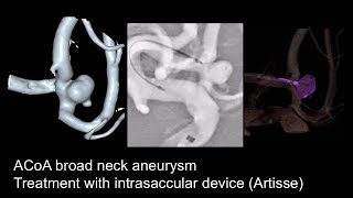 Aneurysm ACoa  Artisse [upl. by Cowie]