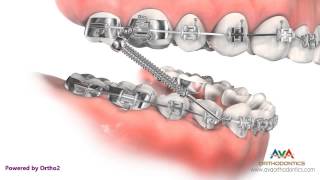 Orthodontic Treatment for Overjet Overbite  Forsus Appliance [upl. by Dorrehs474]