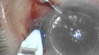 Sutureless DSEAK cornea transplantation using and ocular sealant Resure2011 [upl. by Ynaffat]