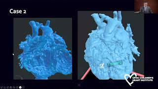 Anatomic Assessment of Complex Transposition Using CrossSectional Imaging and 3D Visualization [upl. by Enimasaj]