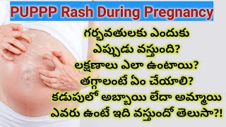 PUPPP Rash During Pregnancy  Reasons  Home Remedies  Boy or Girl  Pregnancy Mom Geethas Tips [upl. by Asseralc]