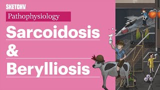 Sarcoidosis Pathophysiology Part 1  Sketchy Medical  USMLE Step 1 [upl. by Eniaj]