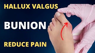 Hallux Valgus Treatment without Surgery [upl. by Tarrance]