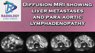 Diffusion MRI showing liver metastases and para aortic lymphadenopathy [upl. by Assi]