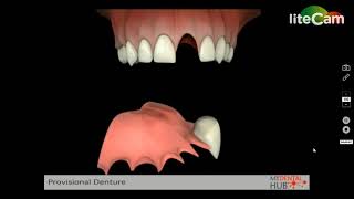 Temporary Replacement Tooth Flipper [upl. by Russia]