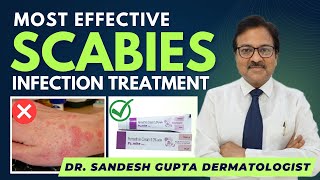 Scabies Treatment Dr Sandesh Gupta Dermatologist Delhi9990804089 [upl. by Byron]