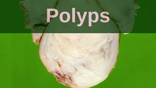 What are Polyps  Pathology mini tutorial [upl. by Horodko]