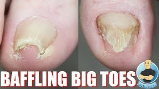 CURVY amp THICK BIG TOENAIL CUTTING TREATMENT [upl. by Selinda163]