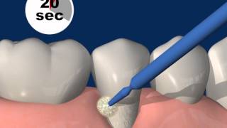 Universal adhesive Futurabond UPart 612 Treatment of hypersensitive tooth necks [upl. by Maguire]