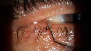 Maskin Probing Chalazion Upper Lid [upl. by Enamrej]