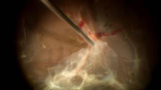 23 g Vitrectomy in Tractional Retinal detachment [upl. by Ttenaej]