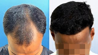 Incredible Hair Transformation in 1 Year 😲  Hair Transplant in Vashi  New Roots [upl. by Nosiaj]