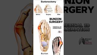 Bunion Surgery medical animation 3d short BiologywithAliya [upl. by Llirret]