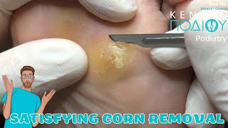 Corn Removal feet κεντροποδιου foot podologos podiatrist corn footcare podiatry callus [upl. by Undis545]